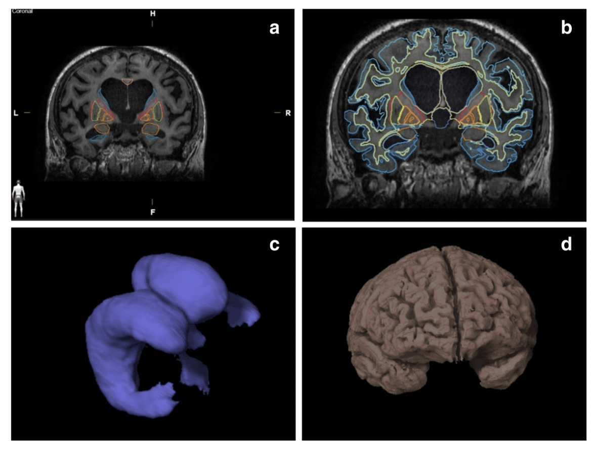 Multilayer Diagnostic Battery for Normal Pressure Hydrocephalus