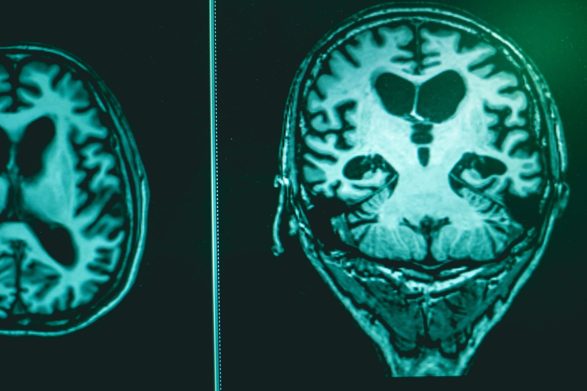 alzheimer's disease on film MRI hippocampus atrophy 